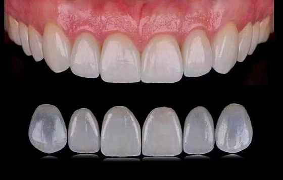 Les facettes dentaires laminées Emax transparentes / les facettes dentaires en porcelaine sont homologuées ISO