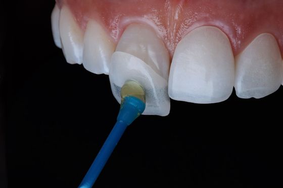 Composé permanent Emax Zirconia Faisceaux de stratification dentaire
