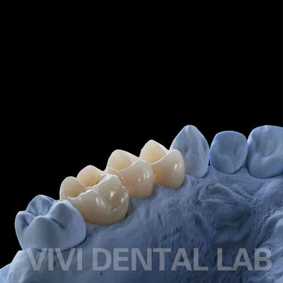 Couronnes de laboratoire dentaire à contour complet à haute translucide