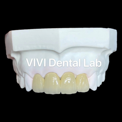 Couronnes en zirconium PFZ couronne en zirconium en porcelaine couronne dentaire couronne