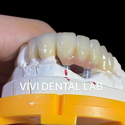 Porcelaine Zirconia pont d'implant dentaire professionnel haute esthétique