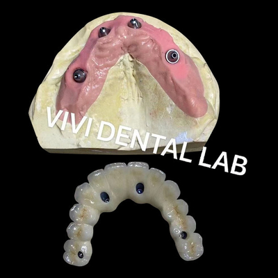 Il est fourre-tout sur quatre pont de zirconium Ivoclar dentiste haute précision
