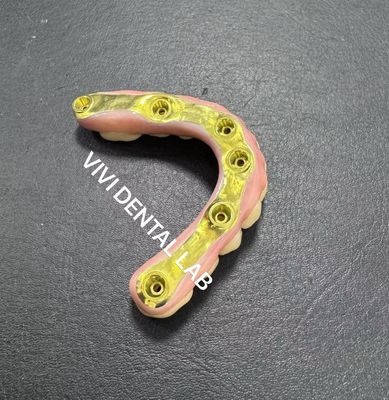 Un pont en zirconium complet avec une barre de titane