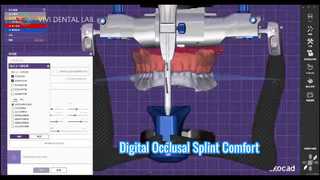 Attelle Occlusale Numérique Confort Précis